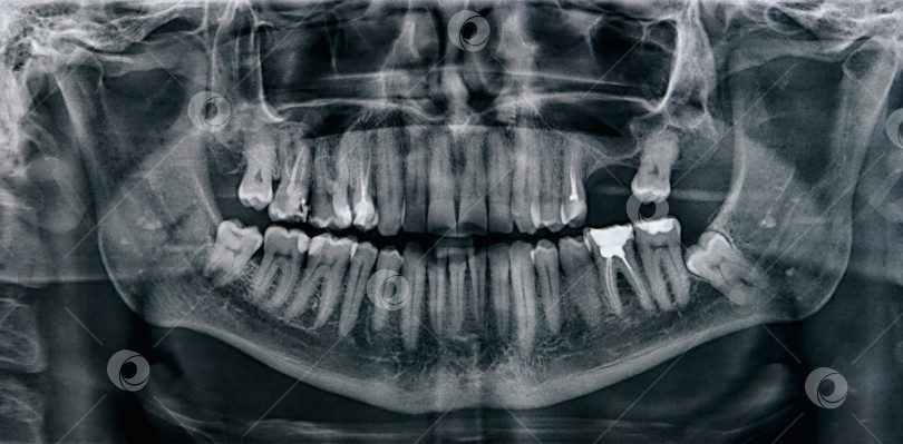 Скачать Рентгенограмма полости рта с зубами. Ортопантомограмма. Панорамный рентгеновский снимок зубов. Тонированный. фотосток Ozero