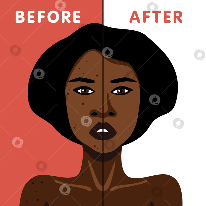 Скачать Векторное изображение афроамериканки до и после лечения кожи от угревой сыпи фотосток Ozero