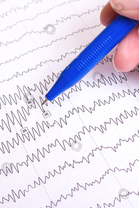 Скачать Результаты электроэнцефалограммы на бумаге, диагностика эпилепсии фотосток Ozero