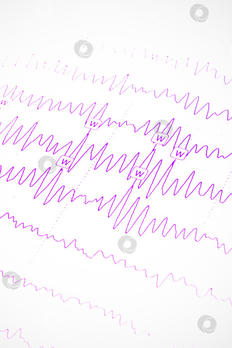 Скачать Результаты электроэнцефалограммы на бумаге, диагностика эпилепсии фотосток Ozero