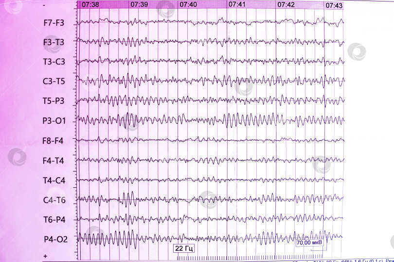 Скачать Результаты электроэнцефалограммы на бумаге, диагностика эпилепсии фотосток Ozero
