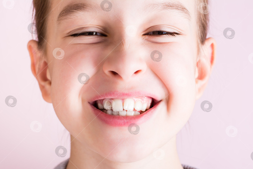 Скачать Портрет девушки с кривыми зубами на розовом фоне. Стоматология и ортодонтия фотосток Ozero