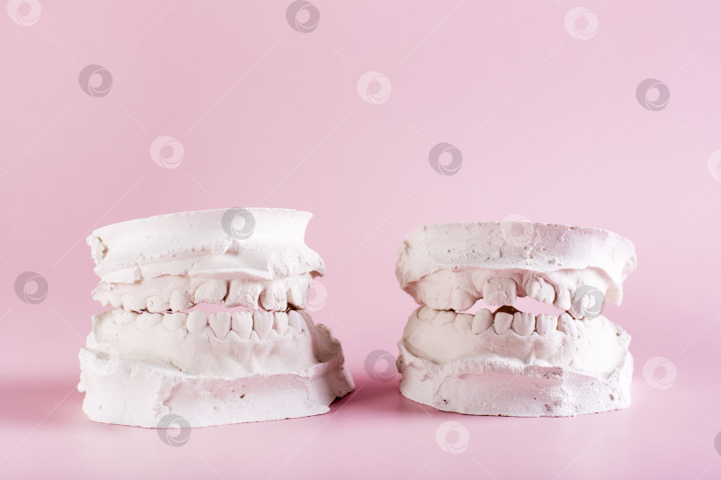 Скачать Два гипсовых слепка кривых детских зубов на розовом фоне. Стоматология и ортодонтия фотосток Ozero