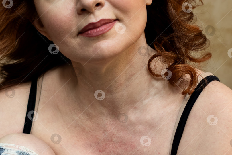 Скачать Крупный план женской груди и шеи с красной пигментированной кожей и морщинами фотосток Ozero